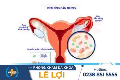 Viêm ống dẫn trứng và những điều cần biết