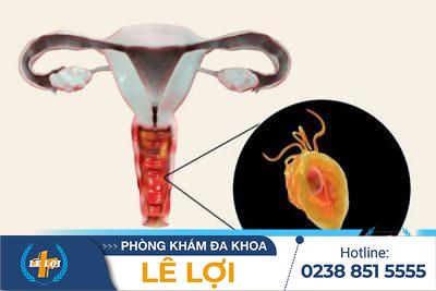 Nguyên nhân gây viêm âm hộ, âm vật